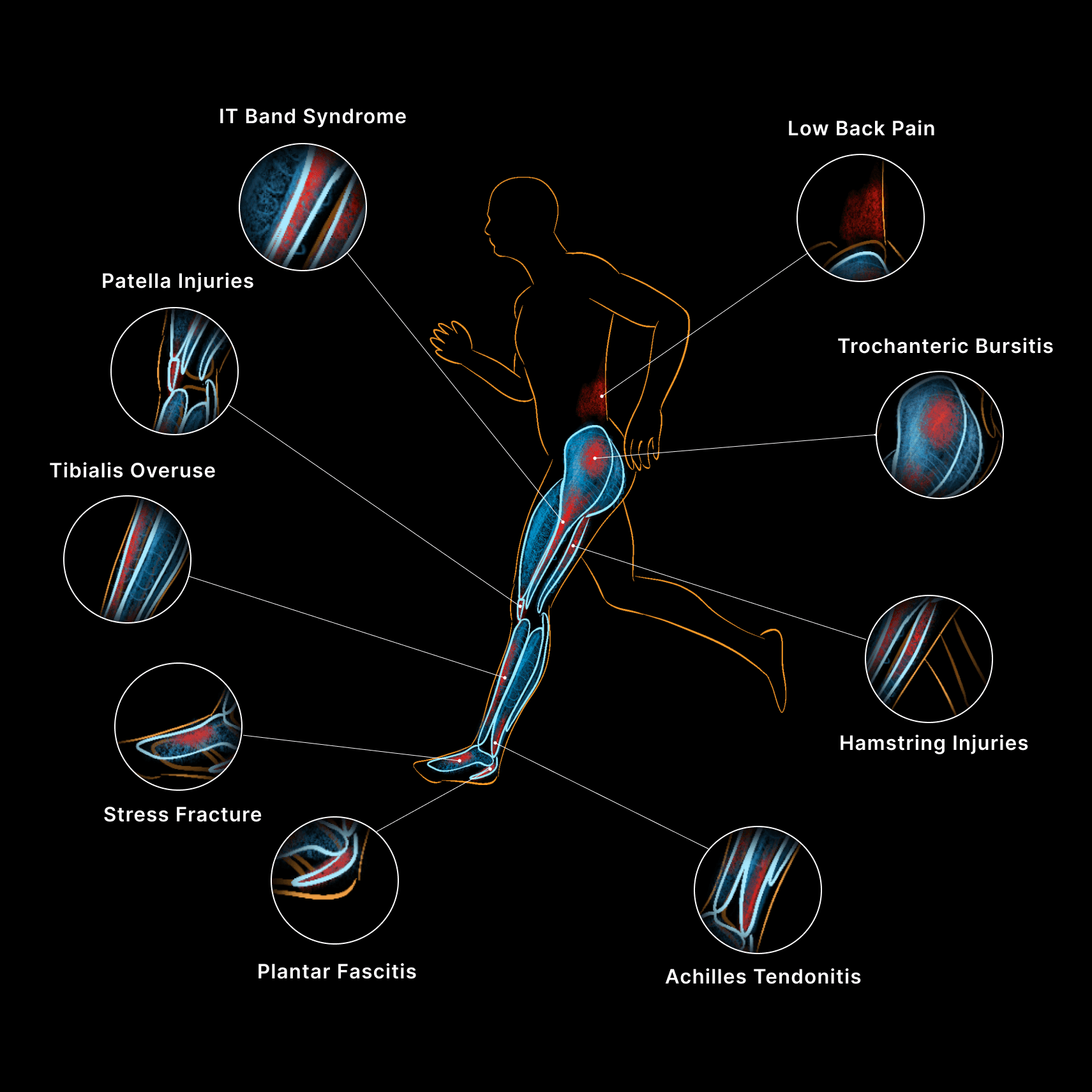 Running injury areas diagram
